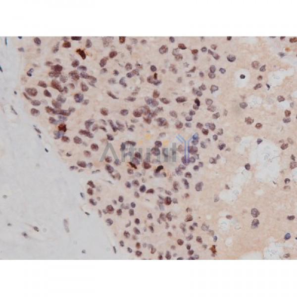 Phospho-Tau (Thr181)[Thr498] Antibody - AF3149 at 1/200 staining Human liver cancer tissue sections by IHC-P.